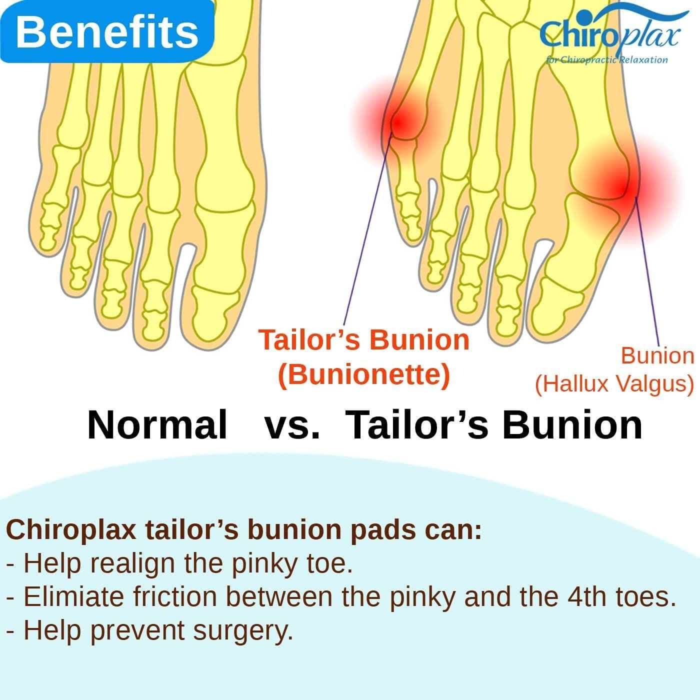 Chiroplax Tailor's Bunion Corrector Pads Bunionette Pain Relief Pinky Toe Straightener Separator Cushion Splint Protector Shield Spacer (4 Pads, Shims - Size Small)